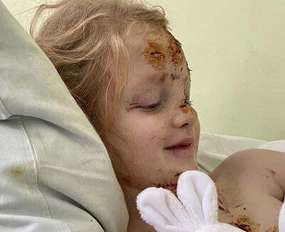 В «Охматдиті» рятують 6-річну Алісу з Херсона, яка втратила зір на одне око через ворожий обстріл