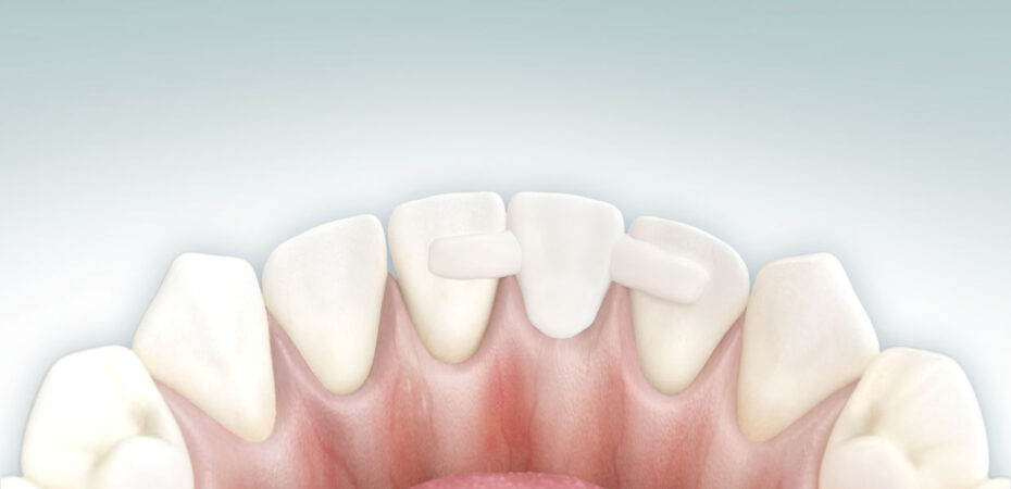 Адгезивный мост: цена, особенности выбора и установки в современной стоматологии